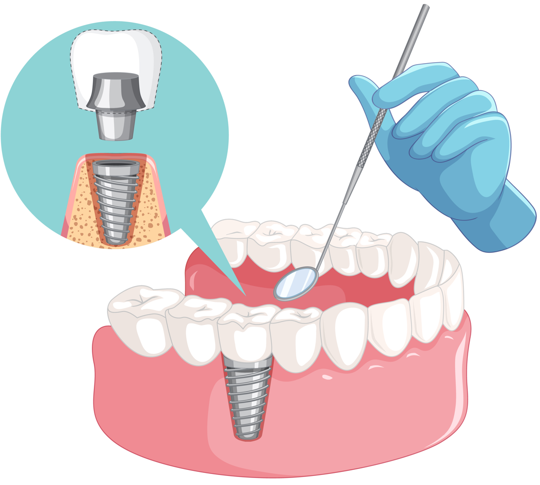 dental implant cost in mumbai