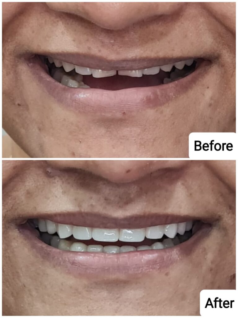 Best Teeth transformation in borivali